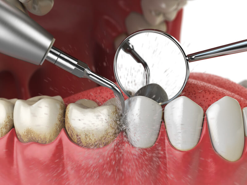 Teeth scaling procedure at 32 Dental Care.