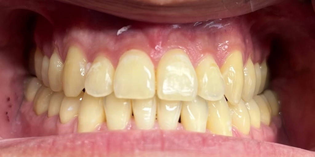 Before whitening