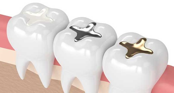 Dental filling problem