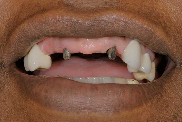 dental crowns and bridges