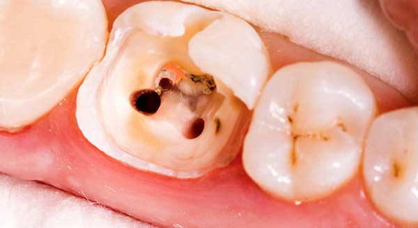 before root canal