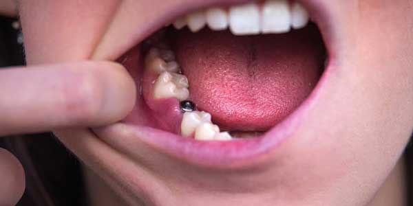dental implanting