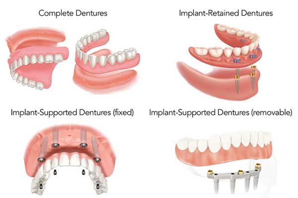 removal denture