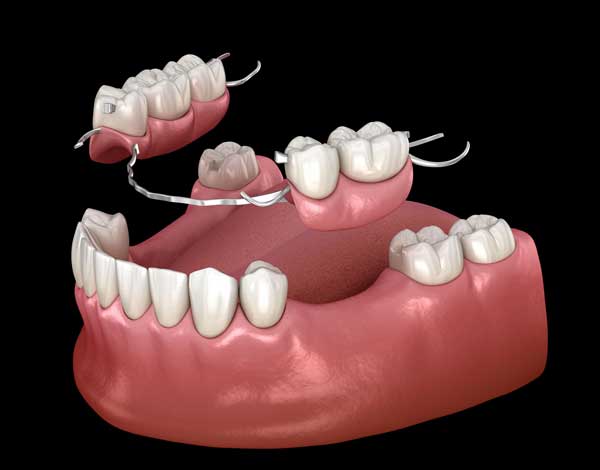 removal denture