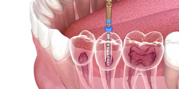 root canal