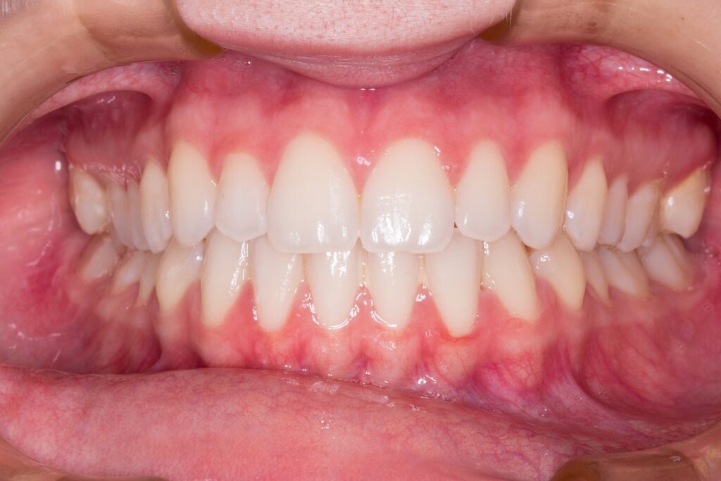 Teeth scaling procedure at 32 Dental Care.